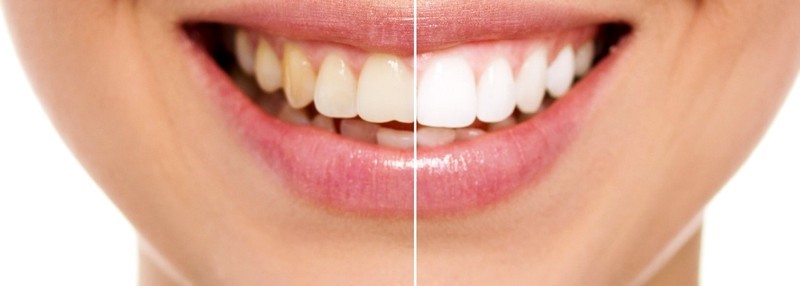 clareamento-dental-a-laser-mitos