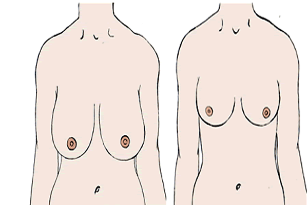 cirurgia-de-reducao-das-mamas-como-funciona
