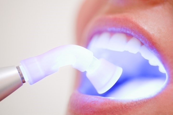 Clareamento Dental a Laser: Como Funciona?