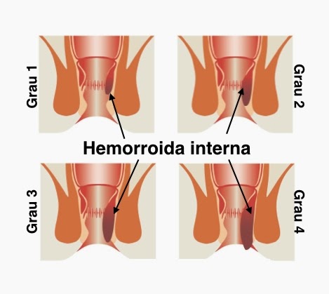 Hemorroida: Causas e Tratamento